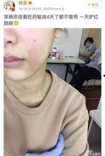 娱乐吃瓜酱过敏